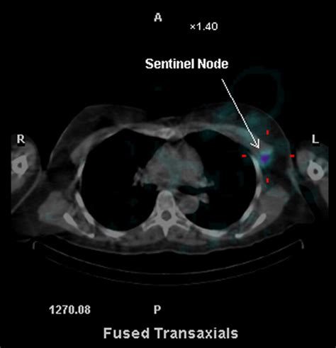 Sentinel Lymph Node Biopsy Information - Dr Ben Lancashire