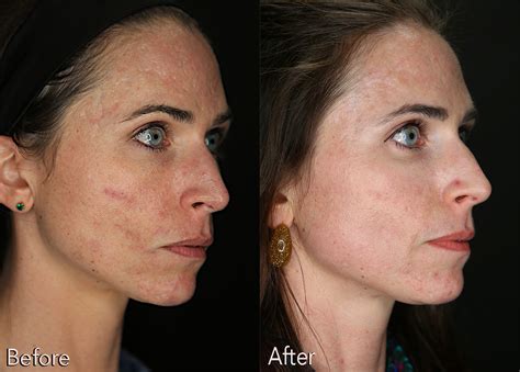 Acne Scar Treatment Before and After | Kaado MD Aesthetics & Anti-Aging Medicine