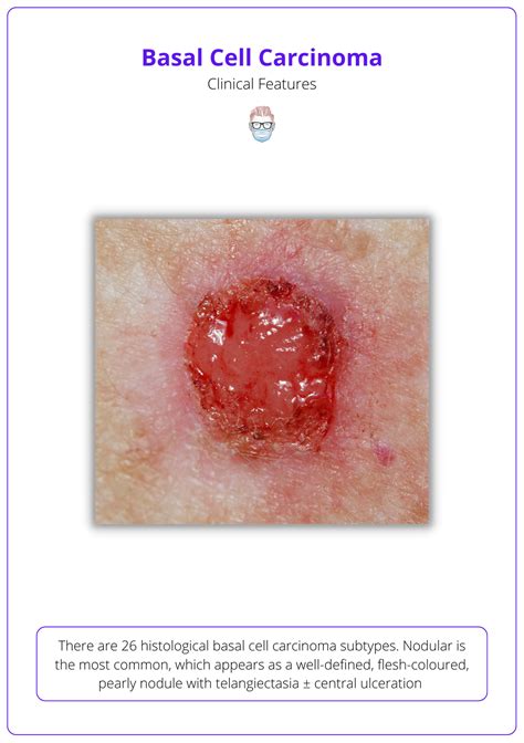 How Deep Is Nodular Basal Cell Carcinoma - Infoupdate.org