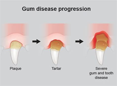 Periodontitis in Dogs: Learn Dog Tooth Decay Stages