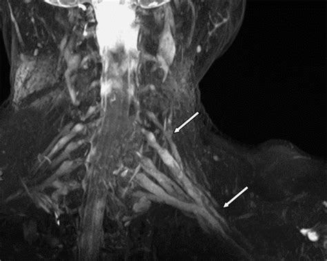 Brachial Plexus Injury Mri