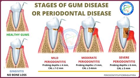 Periodontitis Symptoms