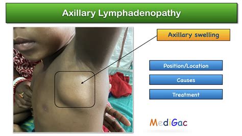 Axillary lymphadenopathy – Position/Location | Possible causes ...