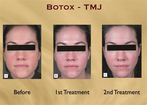 Aesthetics HawaiiBotox for migraines | Botox for TMJ | HONOLULU, HI