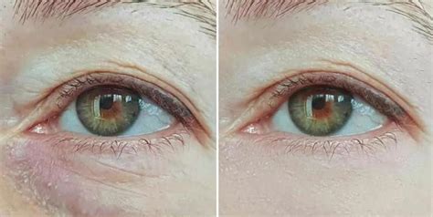 Lumi Eyes Treatment | Surrey, Essex & Kent | Dermis Clinics