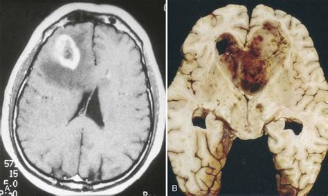 Neoplasms and Cancer | Basicmedical Key