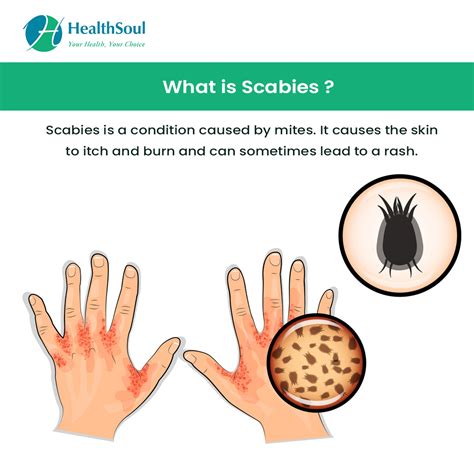 Scabies: Diagnosis & Treatment – Healthsoul