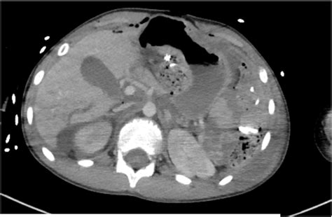 CT images showing liver laceration. | Download Scientific Diagram