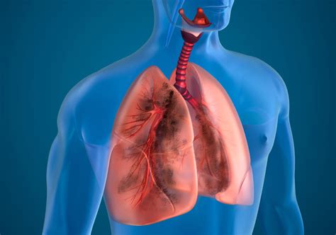 Lung Disease – Pulmonary Practice