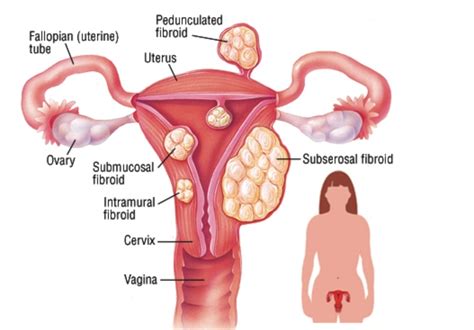 Fibroid Types, Sizes, Location, FIGO Classifications, 51% OFF