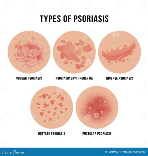 Psoriasis Skin Disease, Types of Derma Problem Stock Vector ...