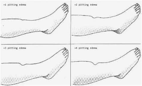 How to document pitting edema