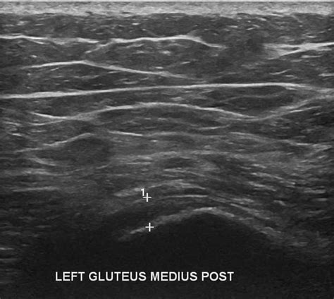 Hip Ultrasound Diagnostic Imaging - Melbourne Radiology