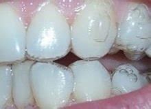 How They Remove Invisalign Attachments Or Buttons… – My Invisalign Blog