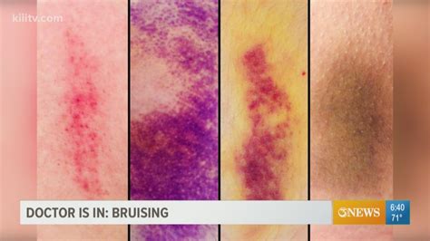 Your bruises tell a story about your body and the best way to treat the ...