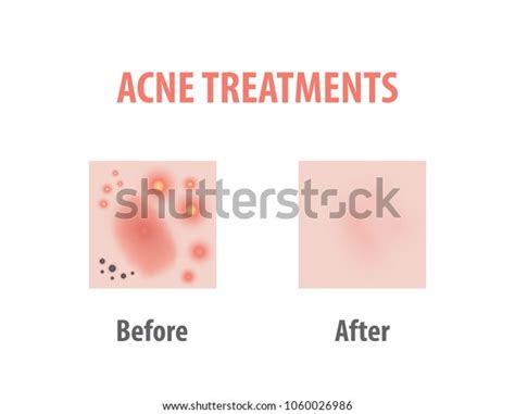 Acne Treatments Diagram Illustration Vector On Stock Vector (Royalty ...