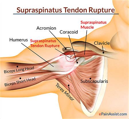 Shoulder Tendonitis Treatment NYC | Shoulder Tendonitis Specialist