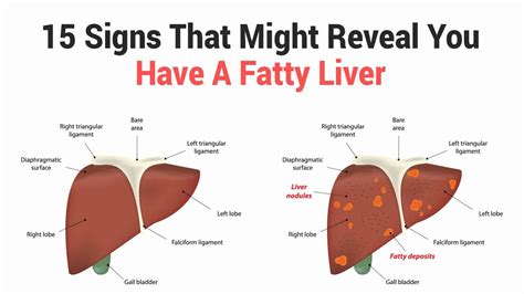 15 Signs That Might Reveal You Have A Fatty Liver| 6 Minute Read in ...