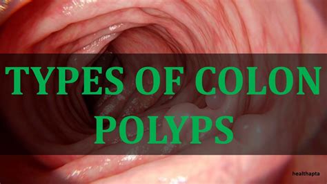 TYPES OF COLON POLYPS - YouTube