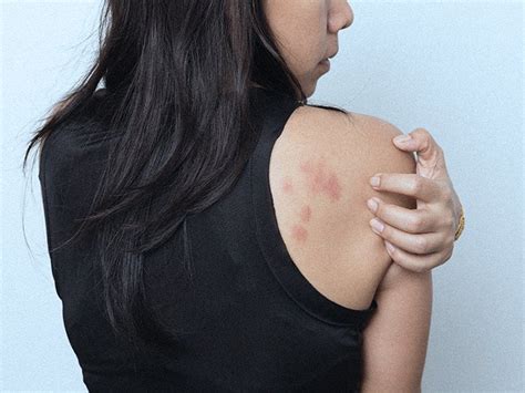 Itchy bumps on skin like mosquito bites: What are they?