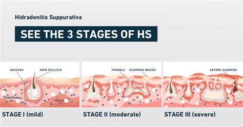 HS Symptoms & Pictures | No BS About HS