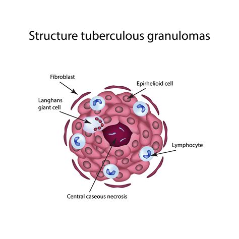 TB Structure