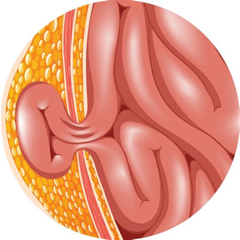 National Hernia Institute - Hernia Types