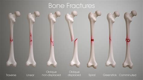 Different Types of Fractures - What You Must Know