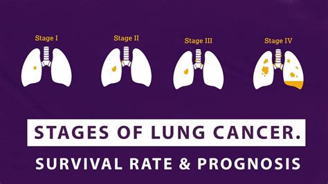 Stages Of Lung Cancer – Survival Rate And Prognosis - Macs Clinic