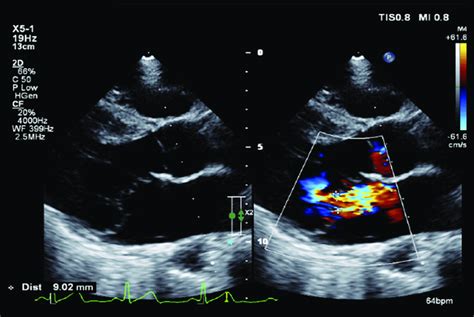 Mitral posterior leaflet prolapse and severe mitral valve regurgitation ...