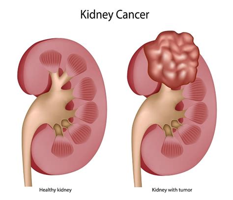 Kidney Masses Overview, Symptoms, Diagnosis & Treatment Options