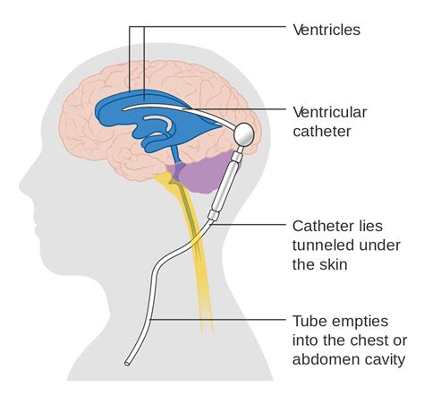 CSF Shunt Placement | Intracranial pressure, Central nervous system ...