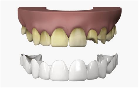 Press On Veneers Teeth - Dental Technician, HD Png Download - kindpng