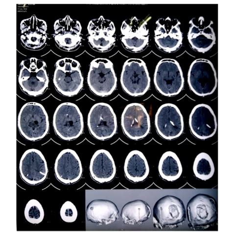 MRI brain showing presence of ventricular ends of right VP shunt ...