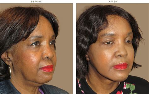 Face Lift – Before and After Pictures * | Dr Turowski - Plastic Surgery Chicago