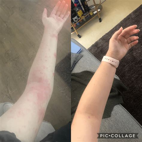 Before and After: 4 months of Phototherapy : r/eczema