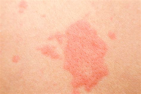 Red Spots On Skin Pictures Causes Treatment Online Dermatology | Images and Photos finder