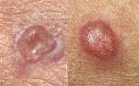 Main Type of Skin Cancer — Their Differences, Histology and Prevention. — Andréas Astier