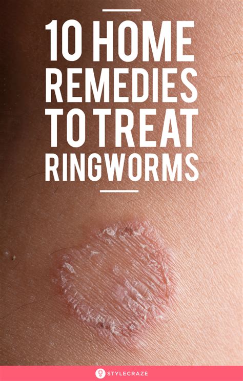 10 best natural home remedies for ringworm treatment – Artofit