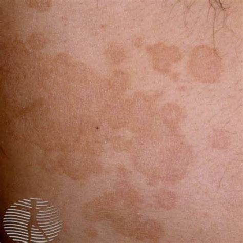 Tinea Versicolor Skin Rash | Images and Photos finder