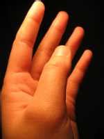 MedicalResearch.com | Left Handedness: Genetic Variants Affect Brain Structure and Function