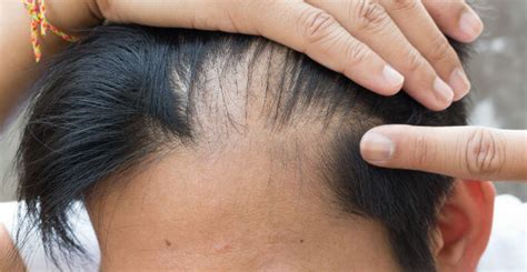 I Have an Itchy Scalp, Do I Have Scalp Psoriasis? - Orlando FL - Dr ...