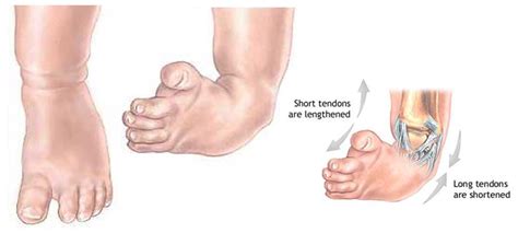 Club Foot - Chicago Foot Care Clinic