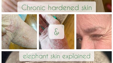 Chronic hardened skin and elephant skin during Topical Steroid ...