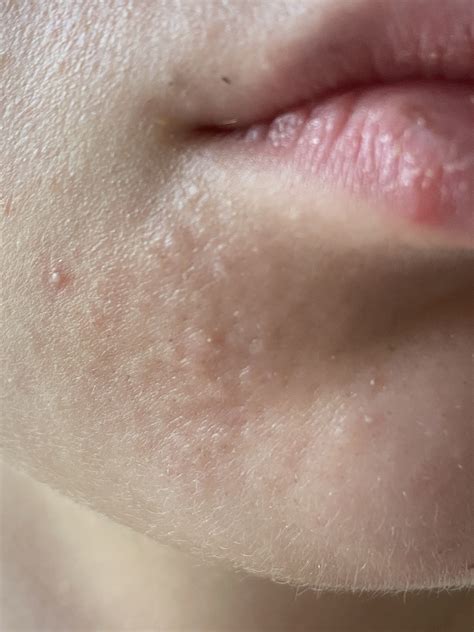 Bumps on chin (sebaceous hyperplasia?) – General acne discussion – Acne.org Forum