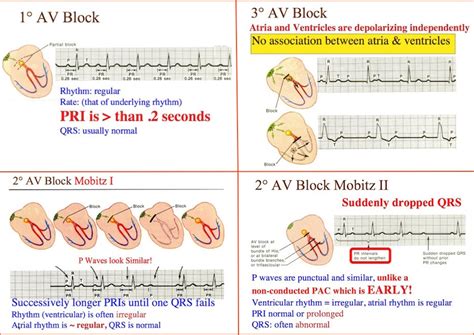 Atrioventricular block (AV block) is a type of heart block in which the ...