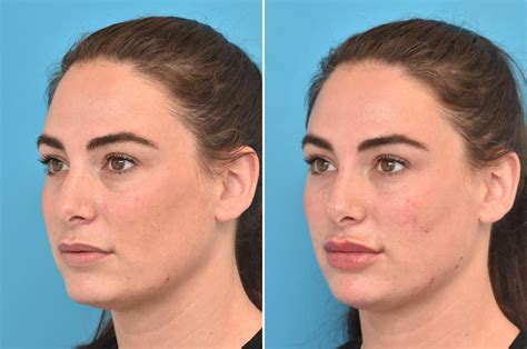 Injectable Fillers photos | Philadelphia, PA | Patient 3764