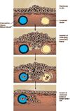 Laryngeal Cancer: Stages | Saint Luke's Health System