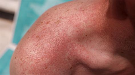 Sun Poisoning: Symptoms, Causes, Treatment, and More