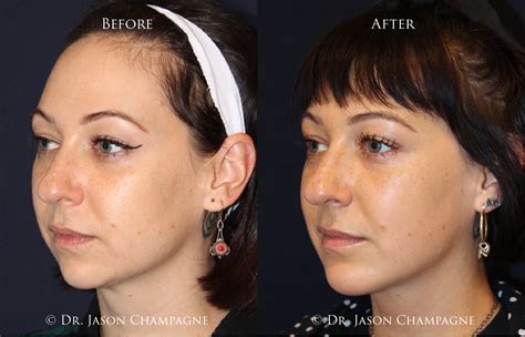 Advanced Radio Frequency Skin Tightening Gallery | Beverly Hills Plastic Surgeon - Dr. Jason ...